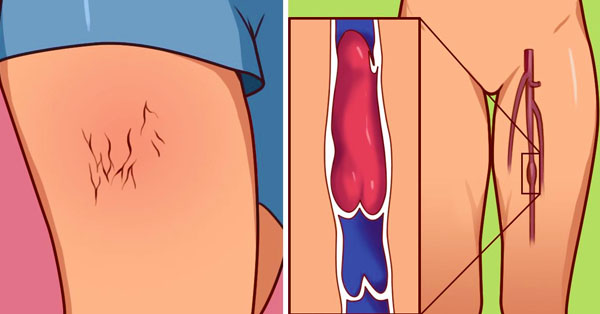 6 Signs You May Have A Blood Clot